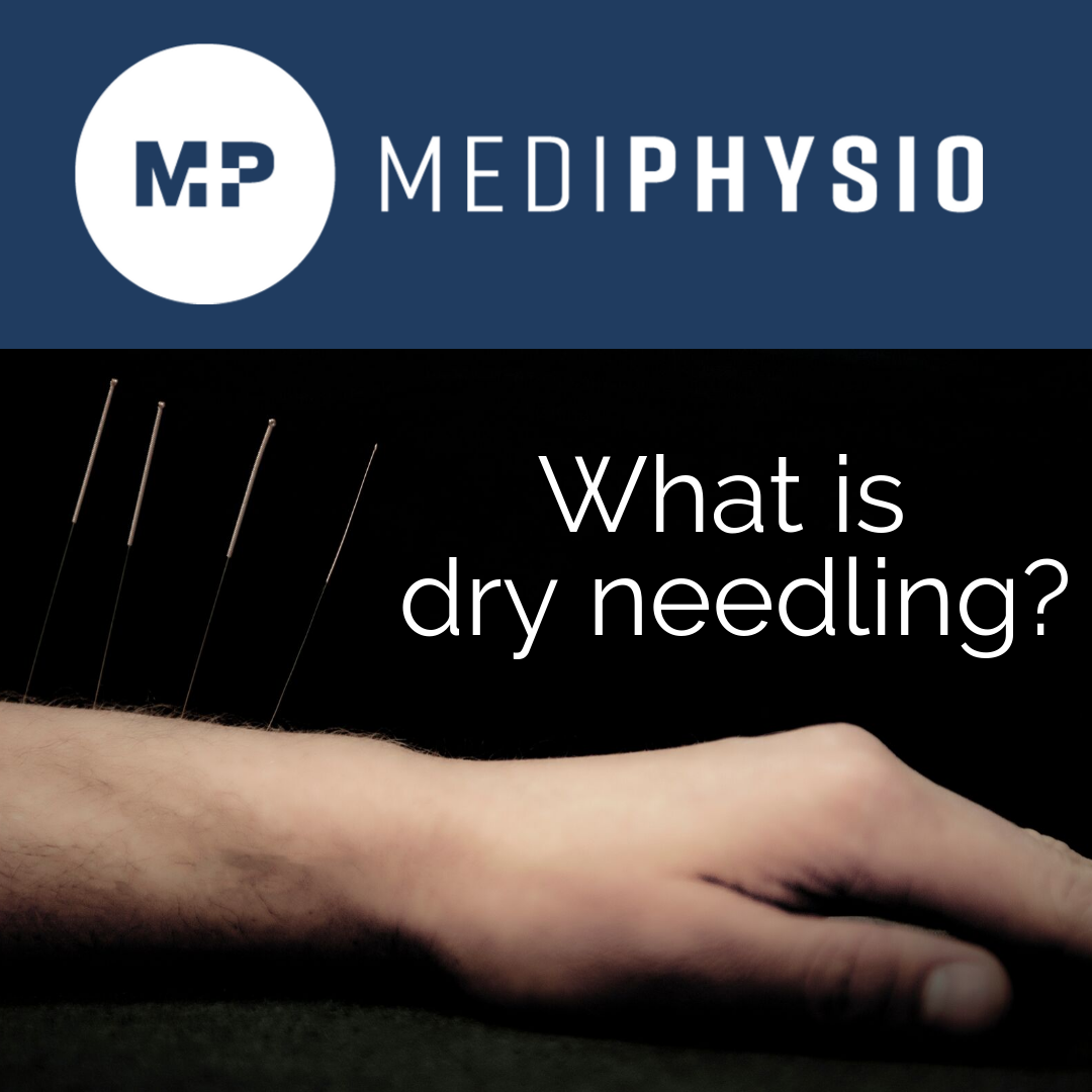 What Is Dry Needling And How Can It Benefit Me Mediphysio