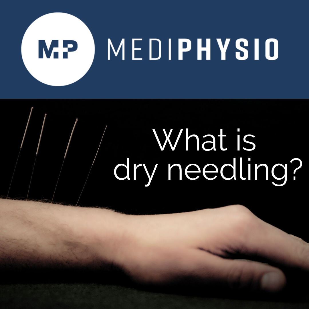 What is dry needling and how can it benefit me? MediPhysio