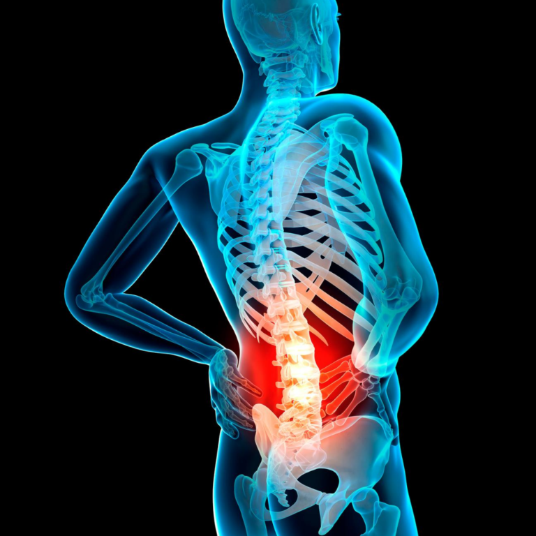 LUMBAR DISC INJURIES AND PHYSIO MediPhysio